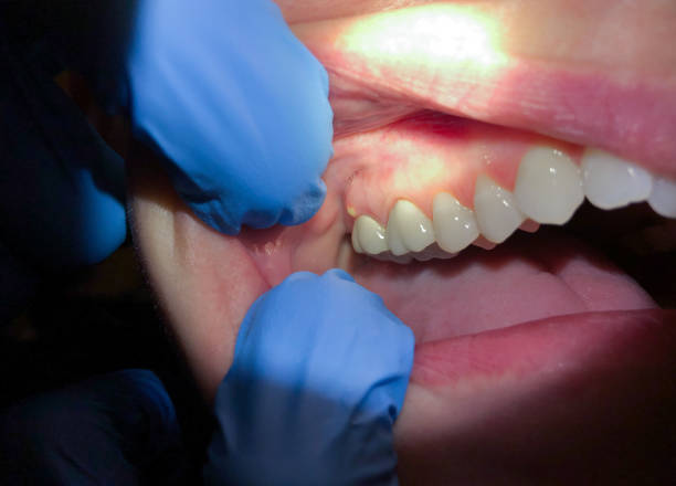 Best Emergency Tooth Extraction in Argos, IN
